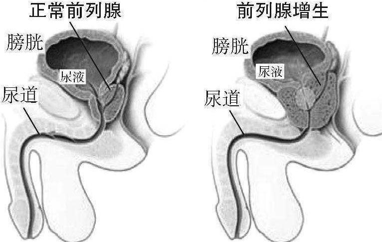 前列腺增生癥——男性的困惑
